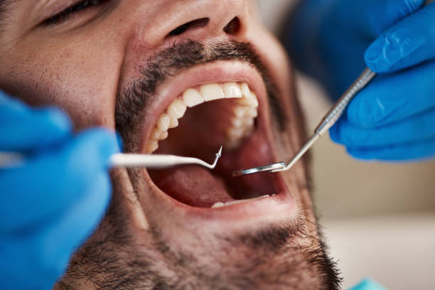 Best Emergency Wisdom Tooth Extraction in Brookfield, MO